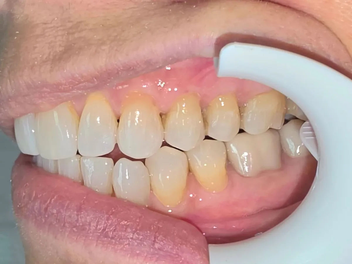 Abfraction restoration - After Treatment