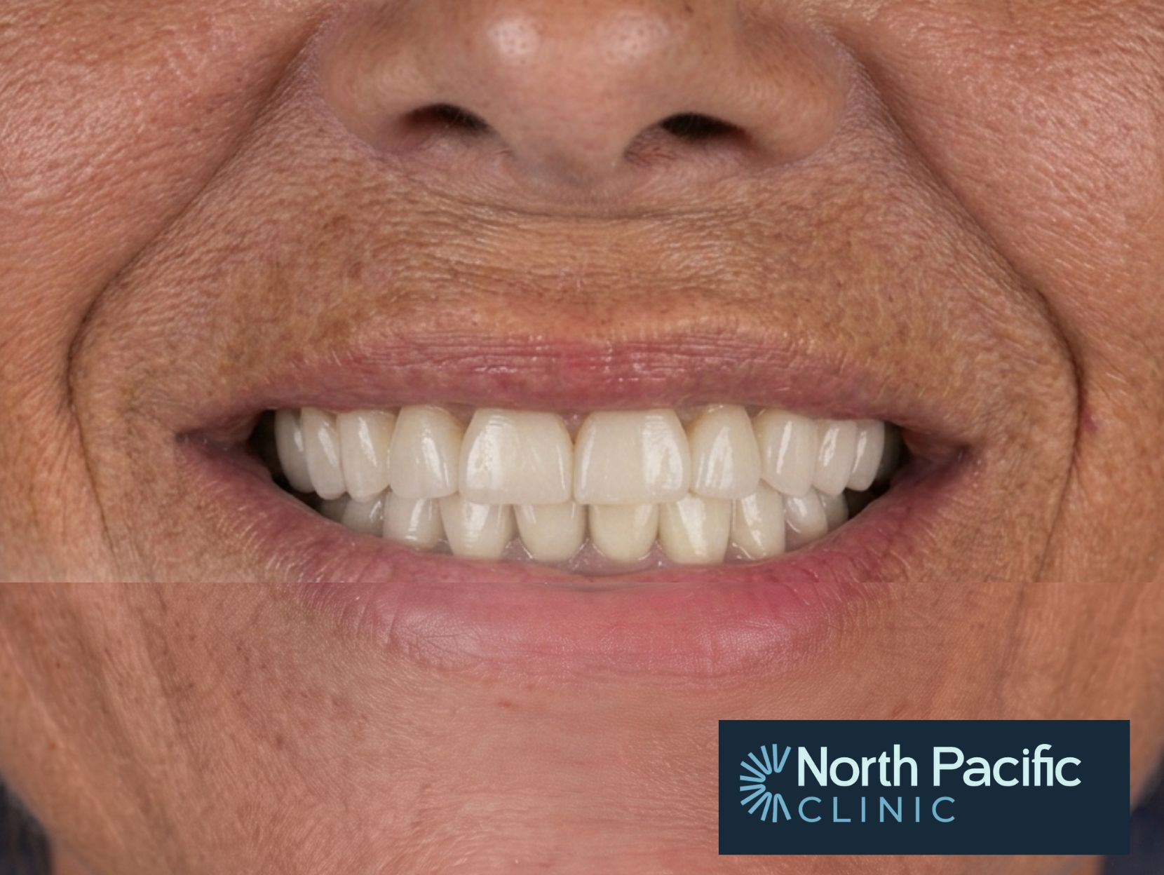 Smile Design - After Treatment