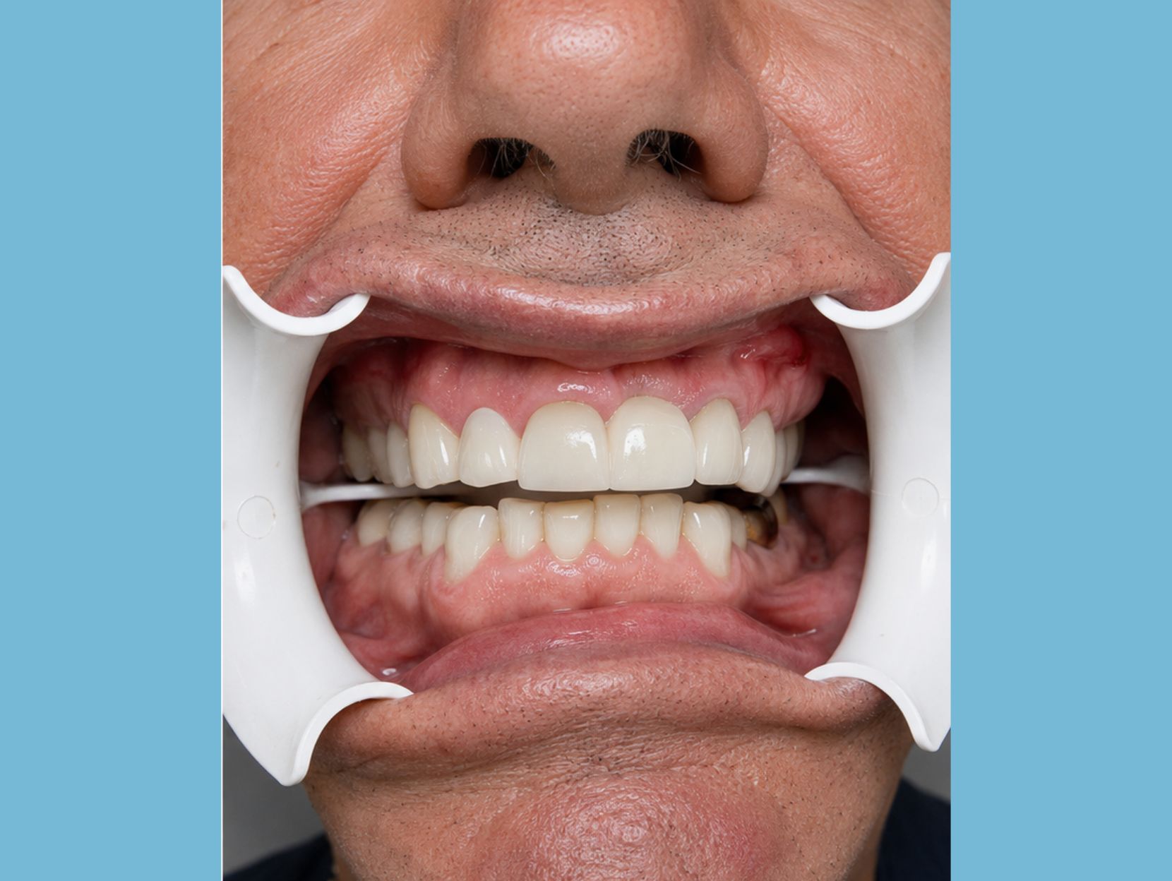 Teeth Whitening - After Treatment