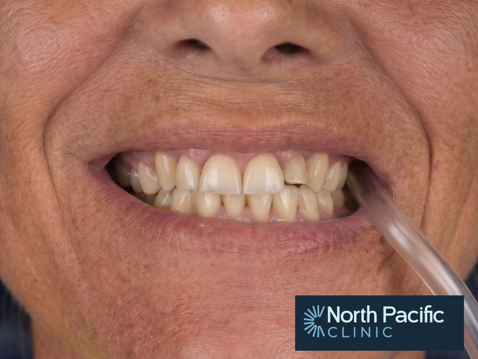 Smile Design - Before Treatment