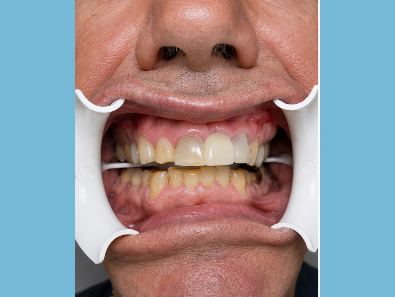 Teeth Whitening - Before Treatment