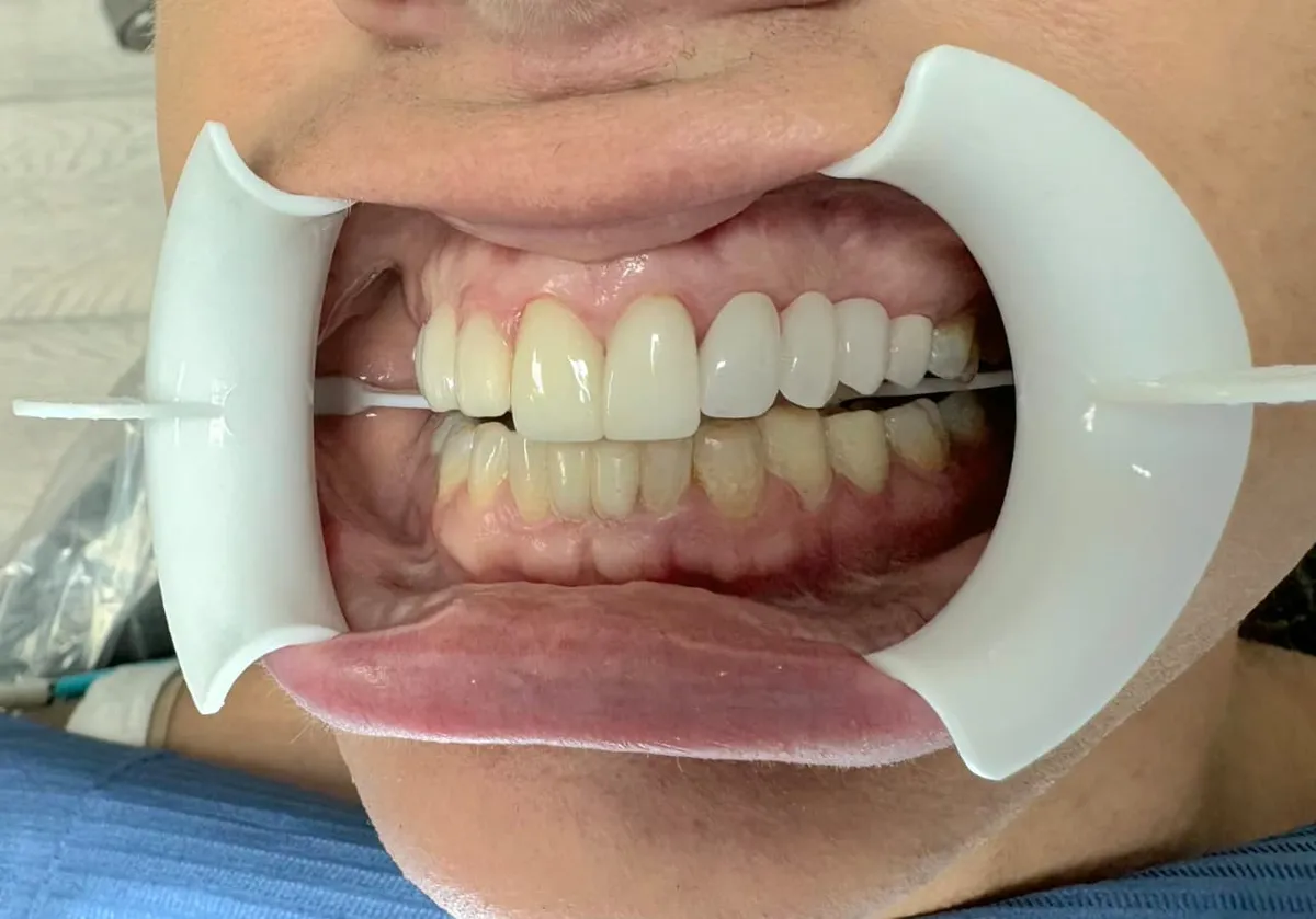 Ceramic Bridge - After Treatment