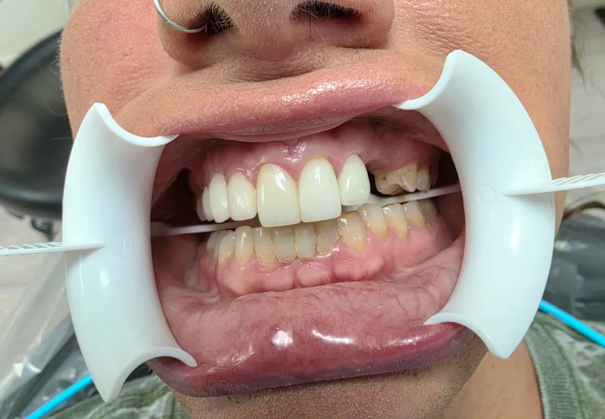 Ceramic Bridge - Before Treatment
