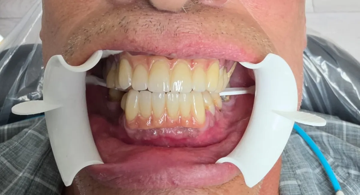 Full mouth rehabilitation - After Treatment