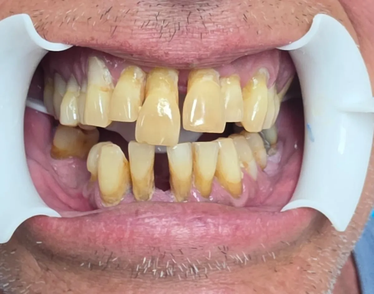 Full mouth rehabilitation - Before Treatment