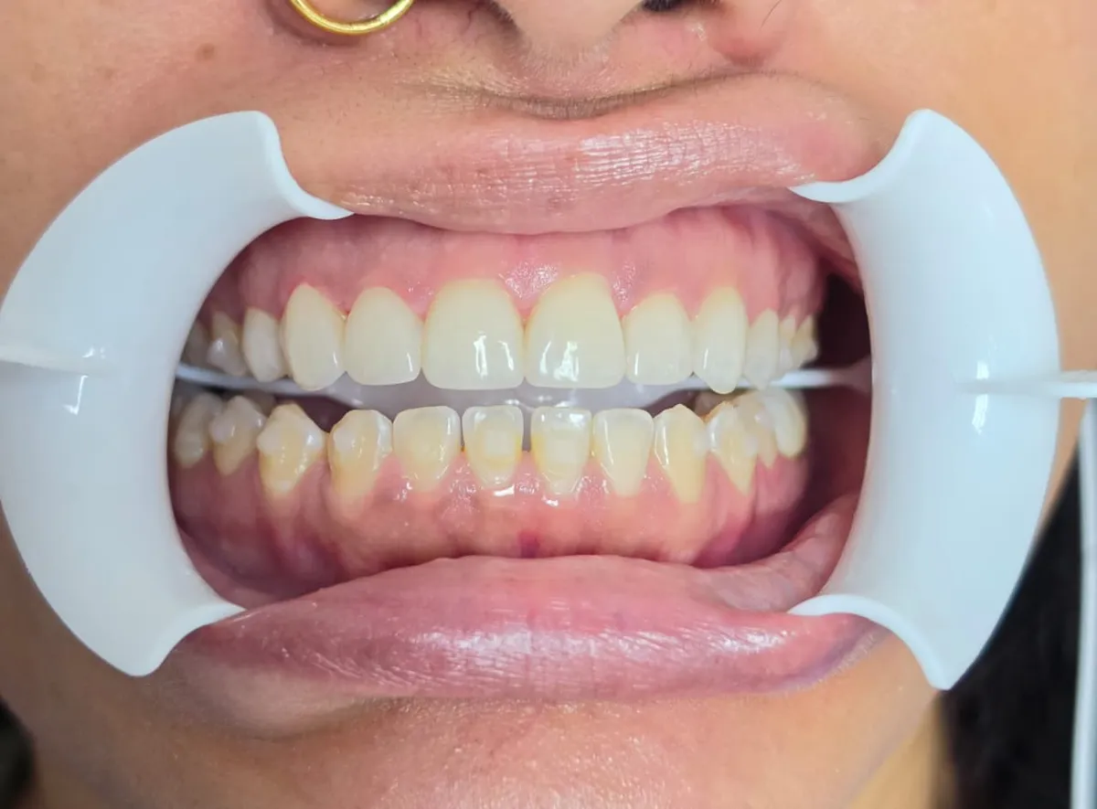 Smile Makeover - After Treatment