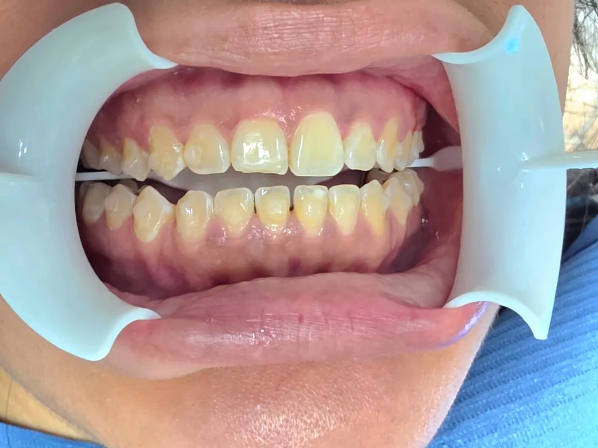 Smile Makeover - Before Treatment