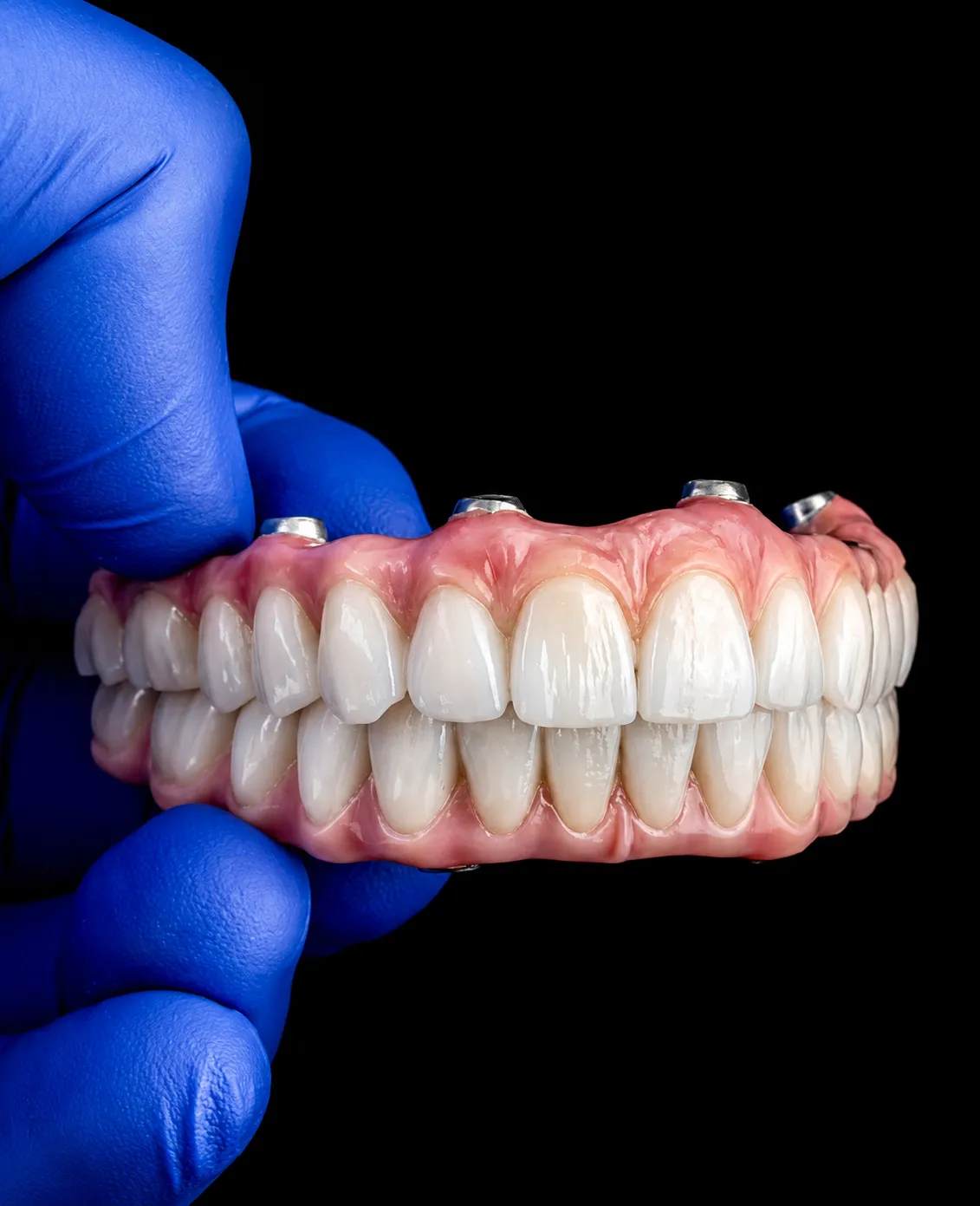 All-on-4® Full-Arch Restoration