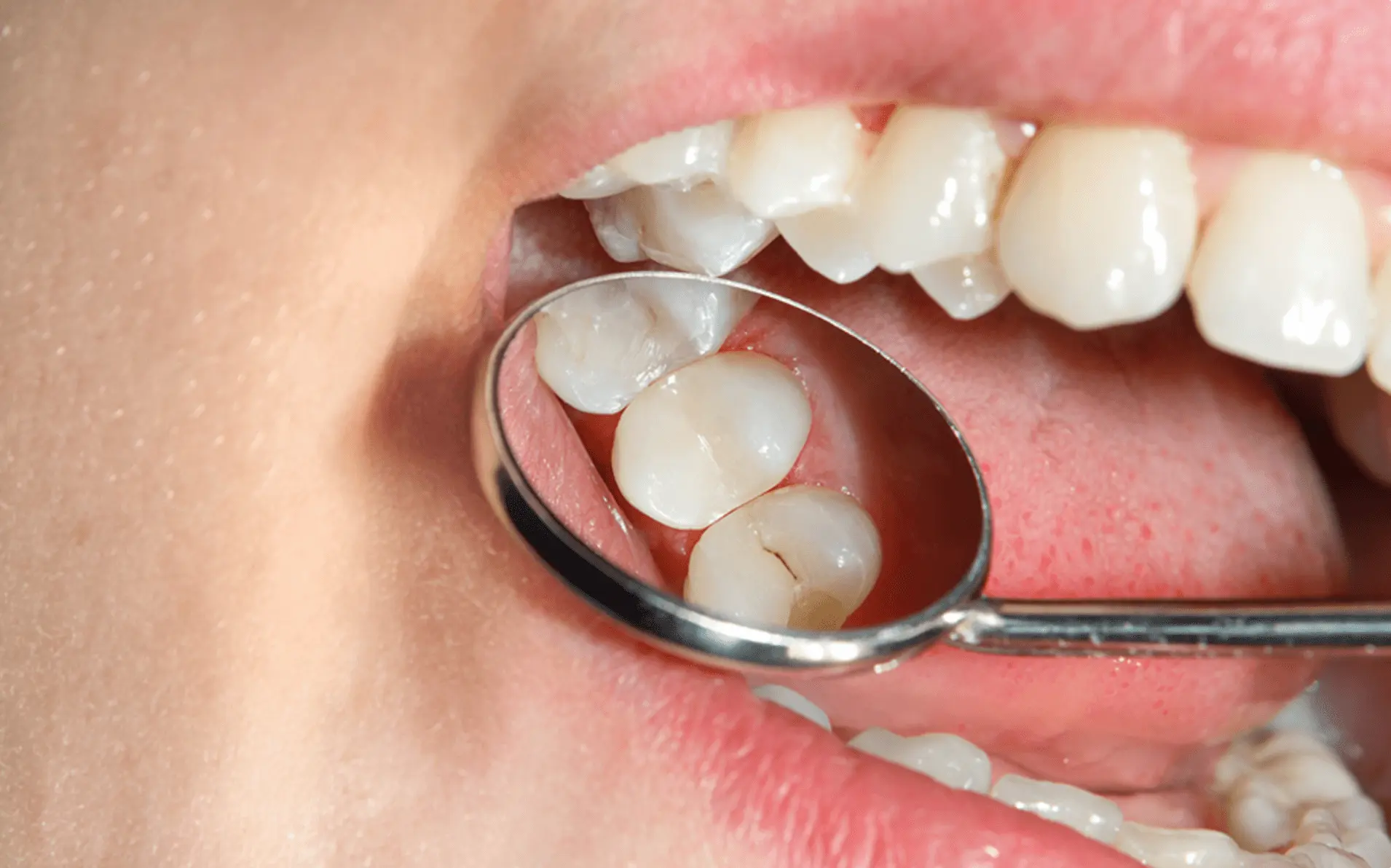 Composite Resin Restorations