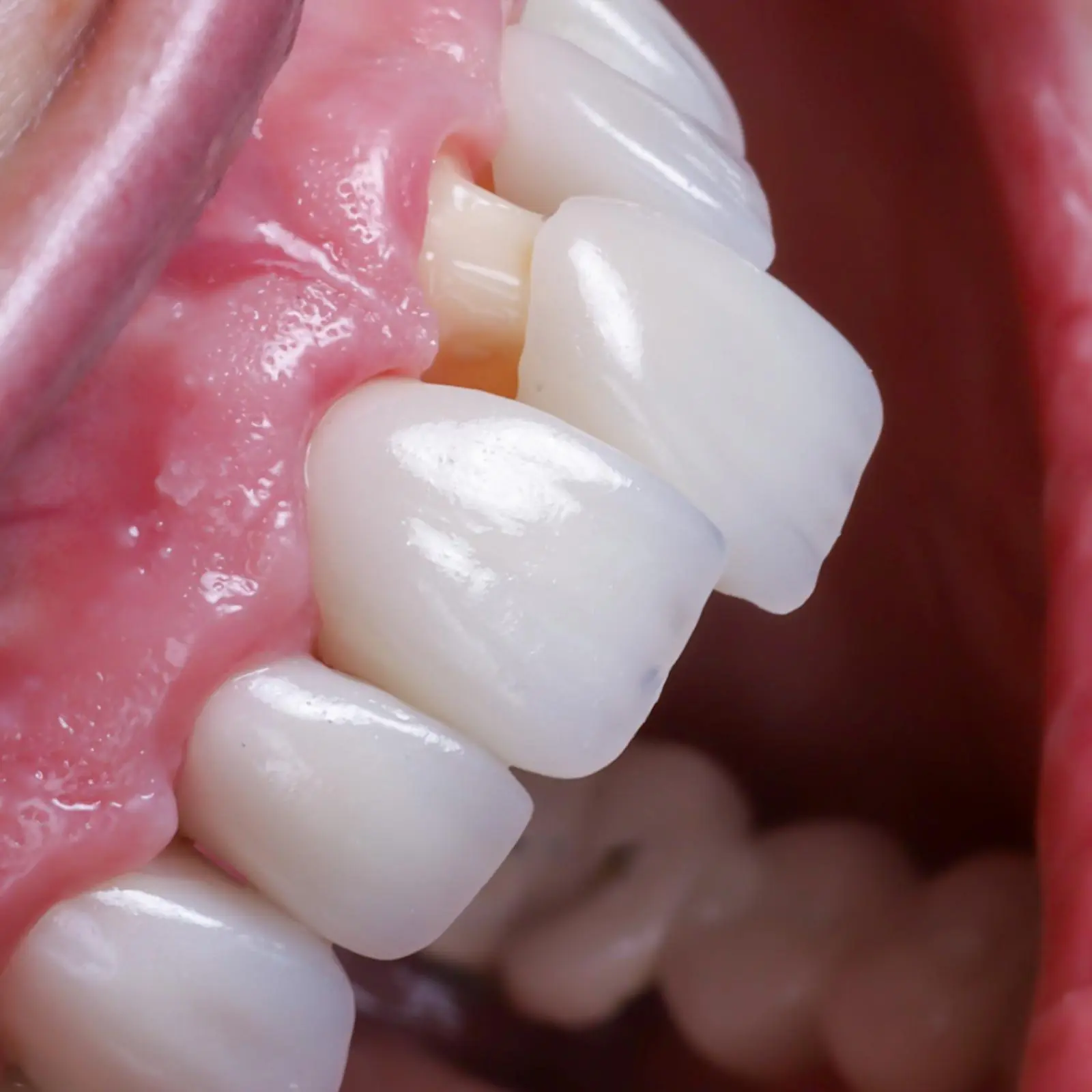 Crowns and Veneers