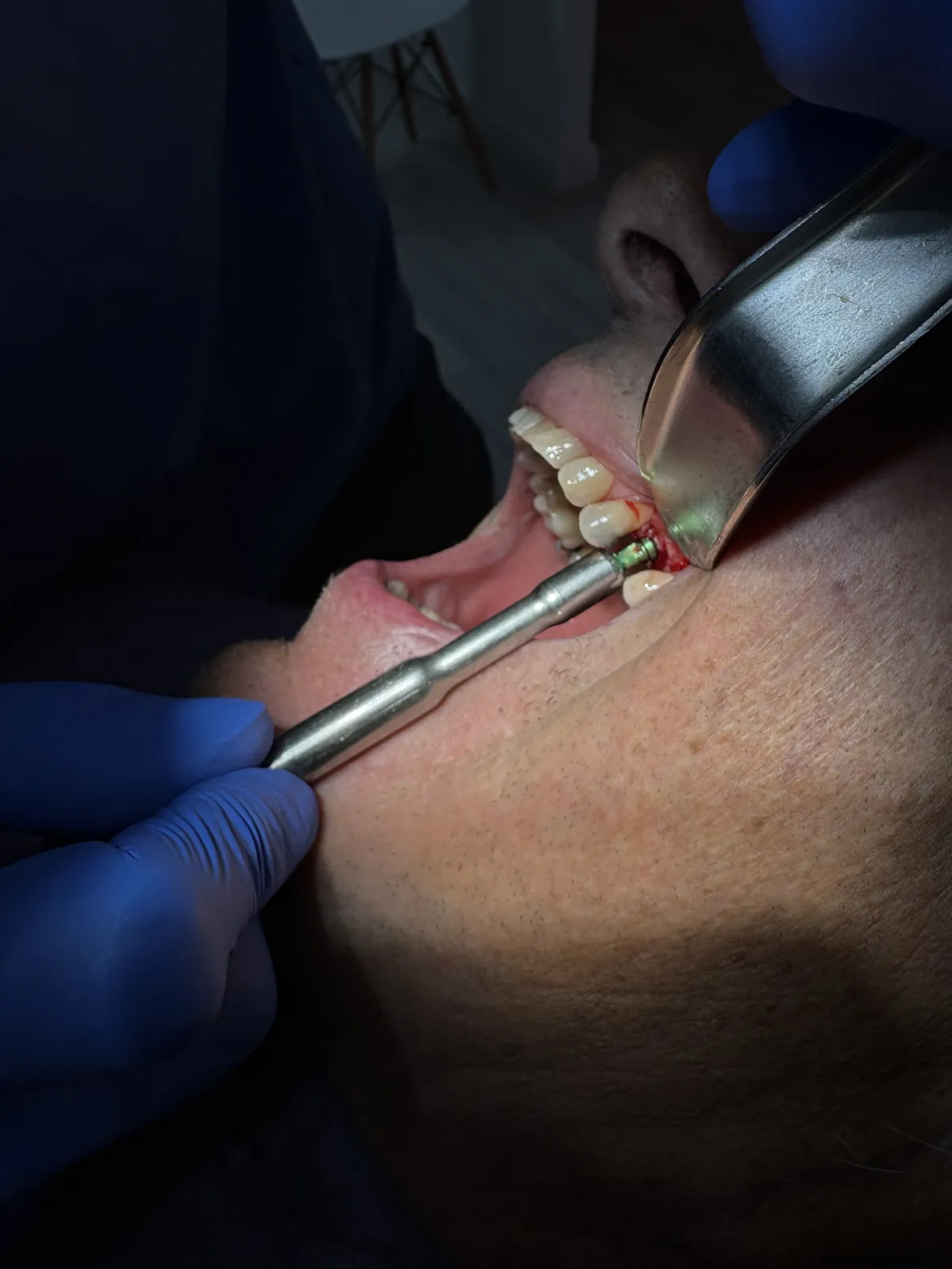 Premium Dental Implants